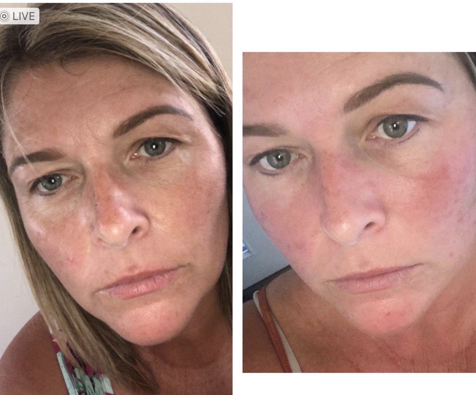 Fractional laser acne and scars result 10