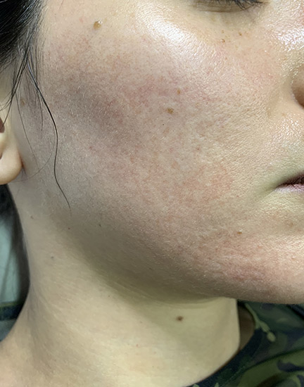 Carbon laser whitening result 8
